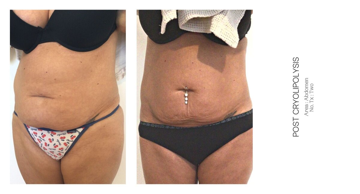 Cryolipolysis Stomach Before and After 3