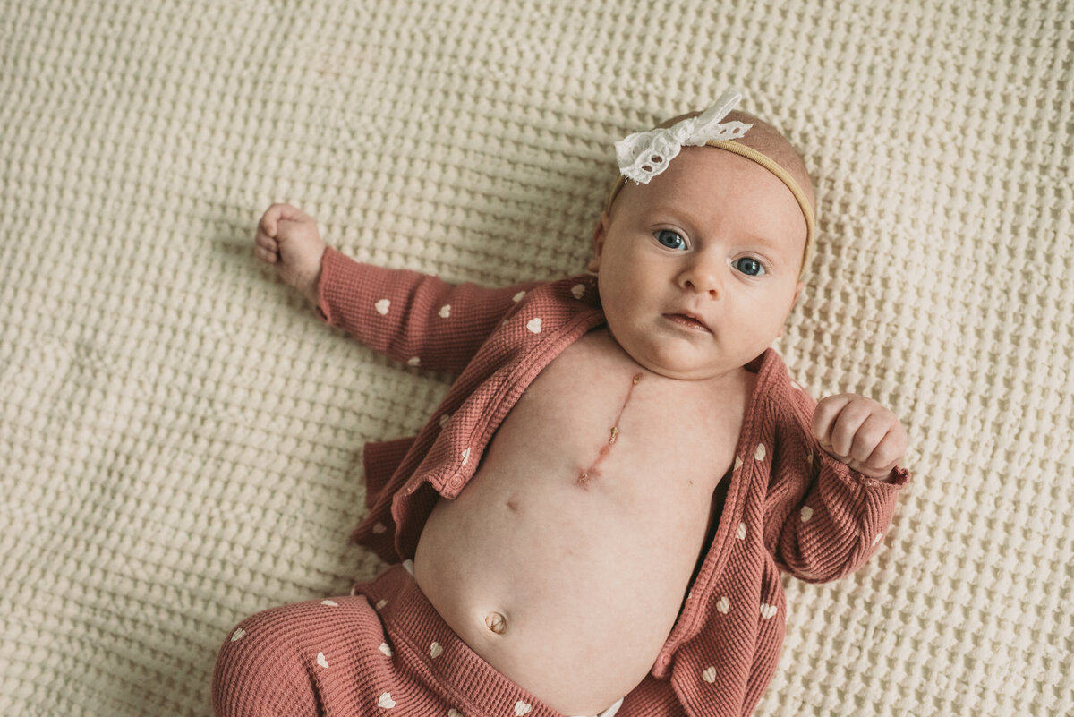 newborn baby with heart surgery scar laying on bed