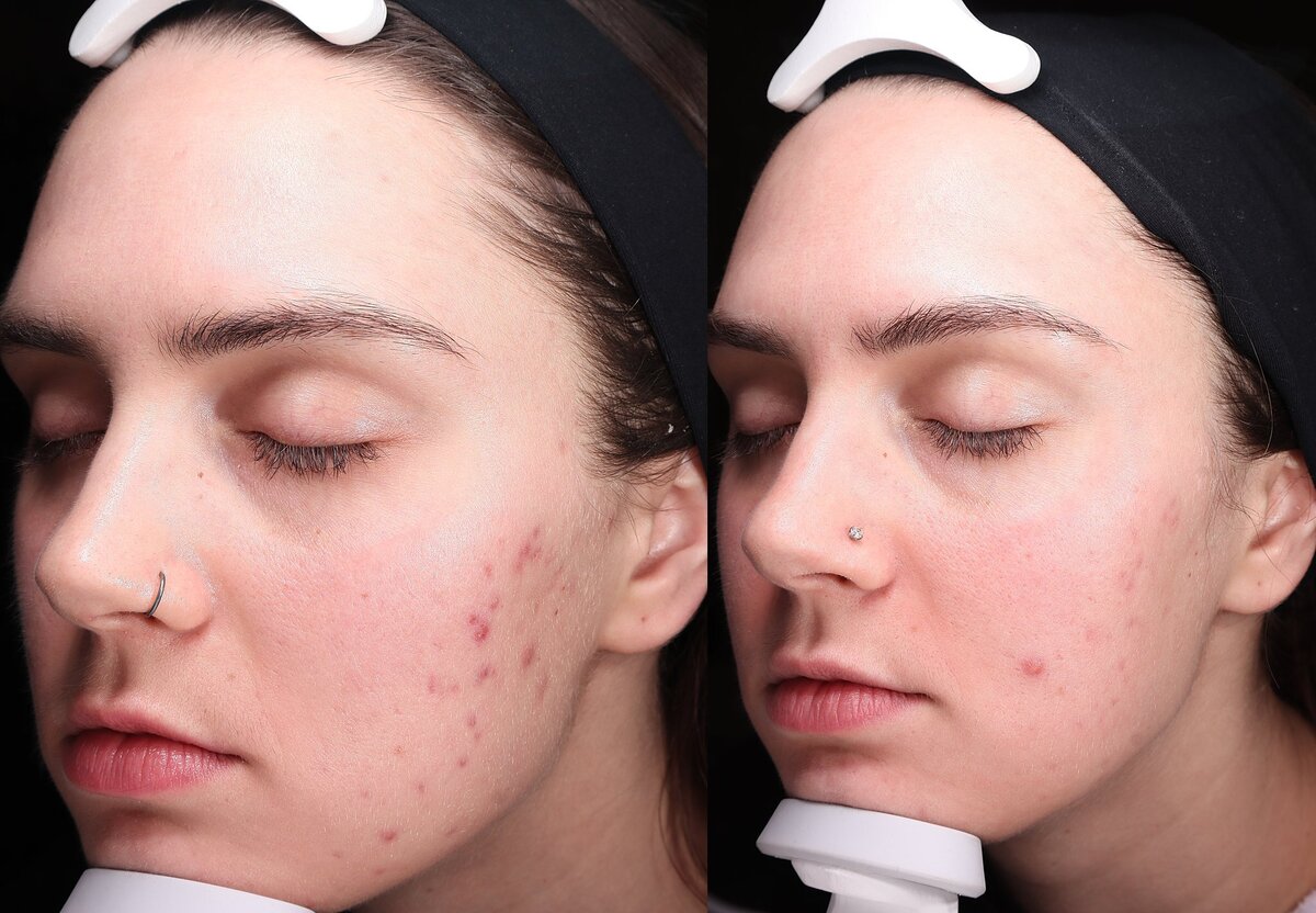 MK Studios_Allure AZ_acne-treatment-flagstaff-az-before-after_0018