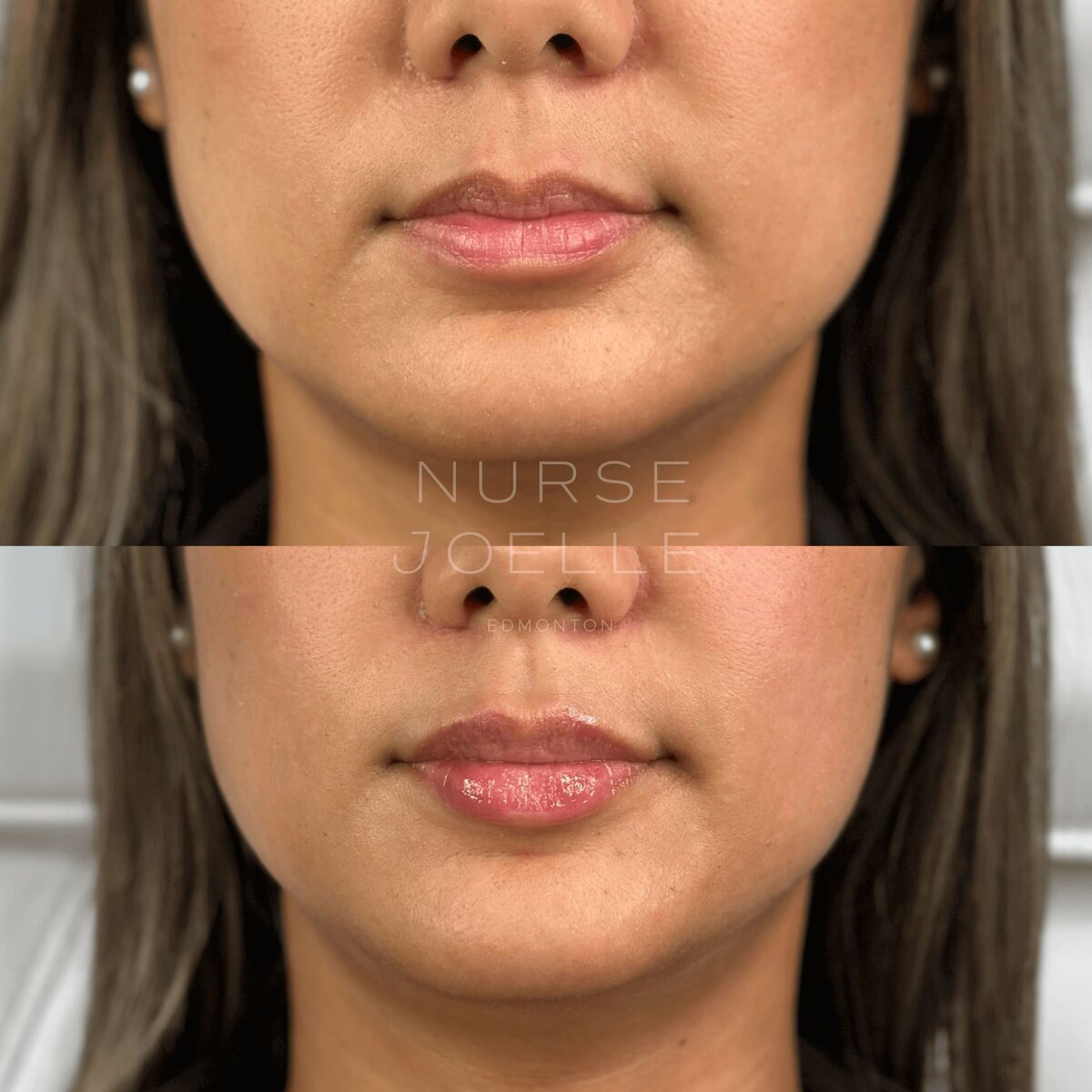 Nurse-Joelle-Cosmetic-Injectables-Before-and-After-1