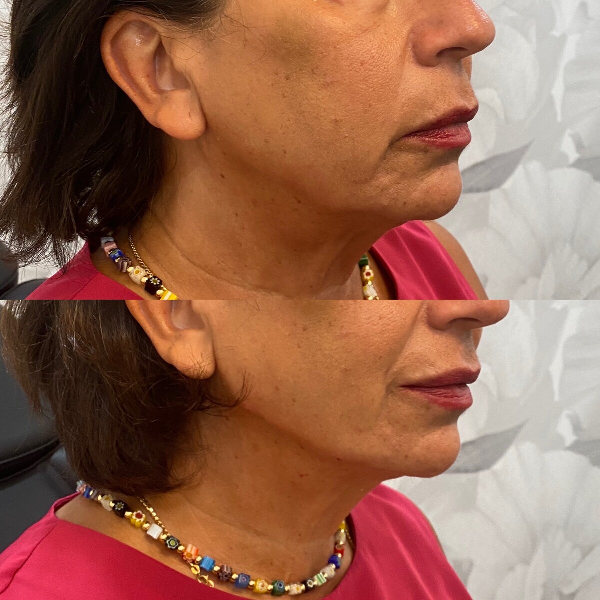 BalancedBeautyBotoxWestwood33