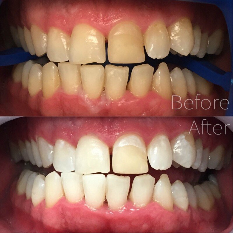 5bbd2eb4044ab93431cad906_before-after-5-zoom-whitening