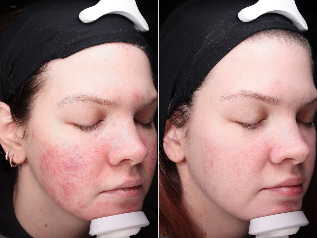 Allure AZ_flagstaff-acne-skin-results-medical-spa_0040