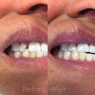 ling20on20an20upper20front20tooth20due20to20decay20and20broken20filling.JPEG