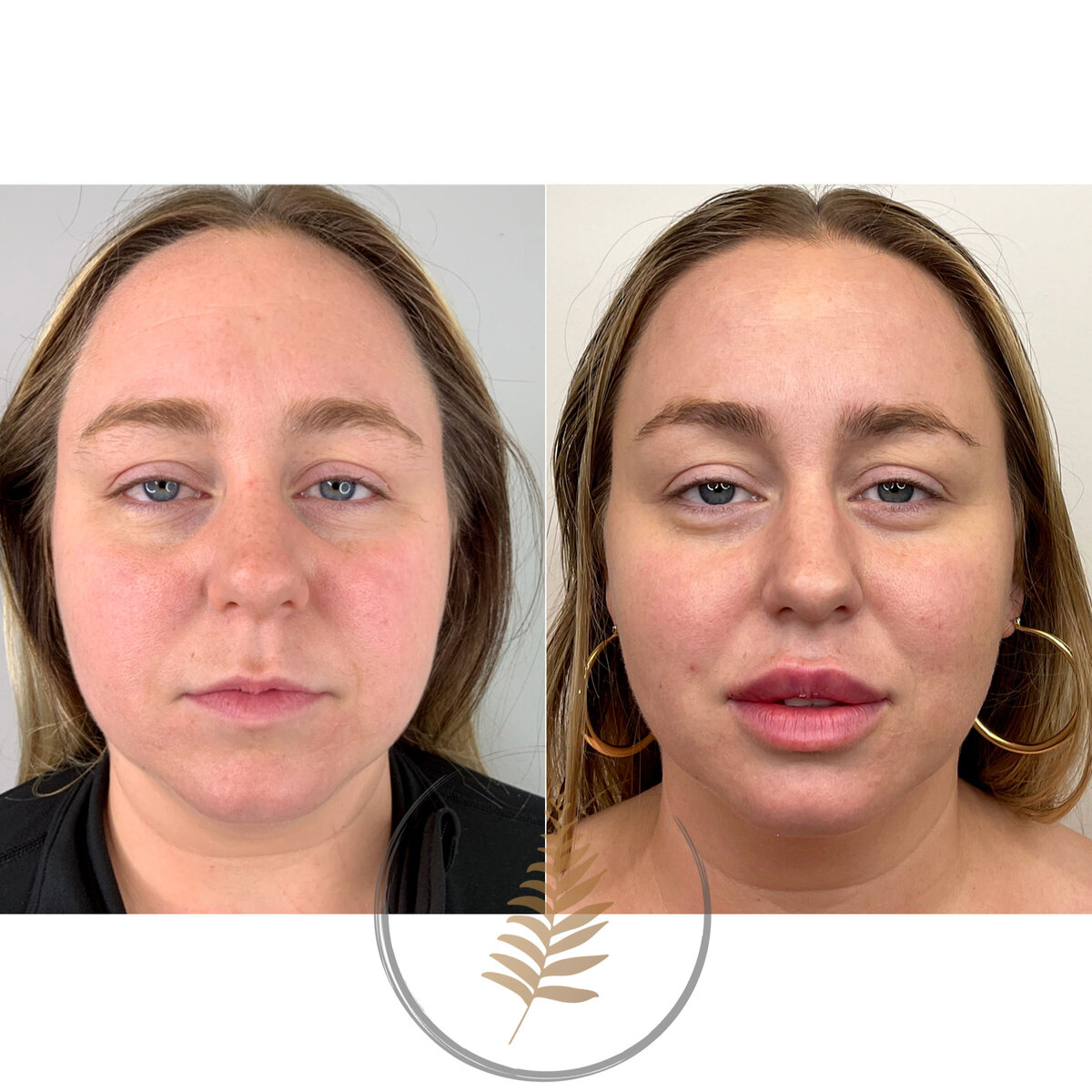 FACESINBLOOM_BEFOREAFTER_LIPS_09