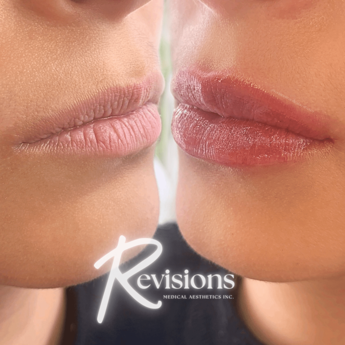 Best_Lip_Filler_Nurse_Injector_in_Ottawa (1)