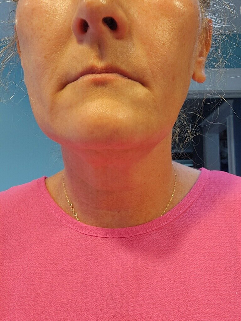 RF neck before looking straight