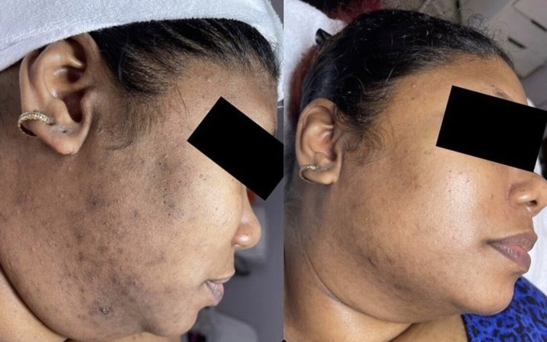 hyperpigmentation treatment before and after