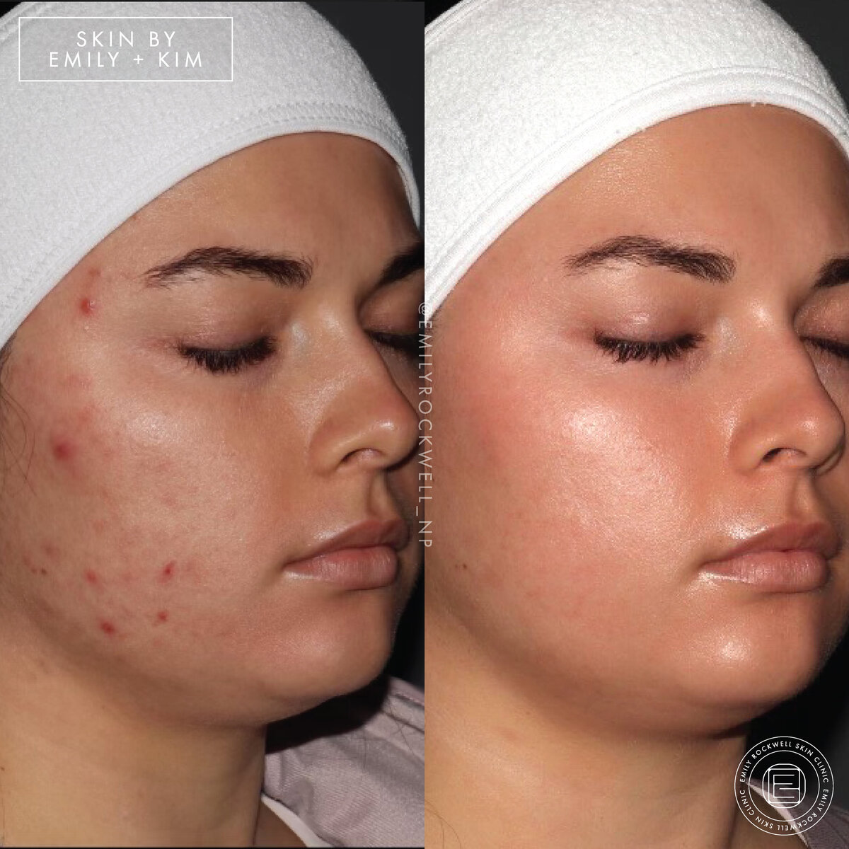 NEW ACNE SCARRING POST-13