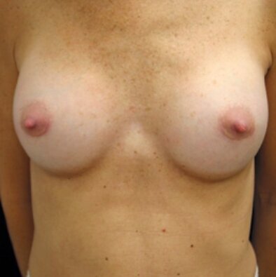 after_breast 7
