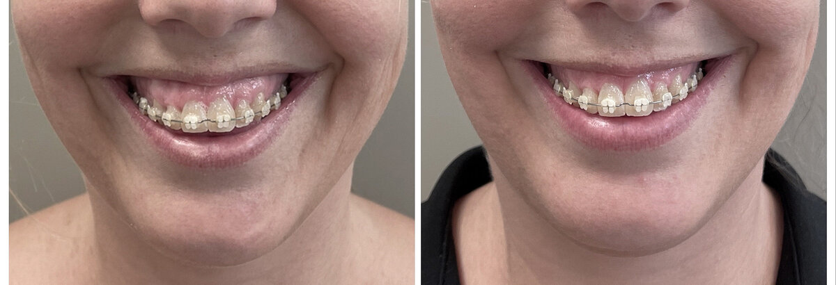 Botox gummysmile before after door cosmetisch arts Lizenka Adriaanse in Rotterdam