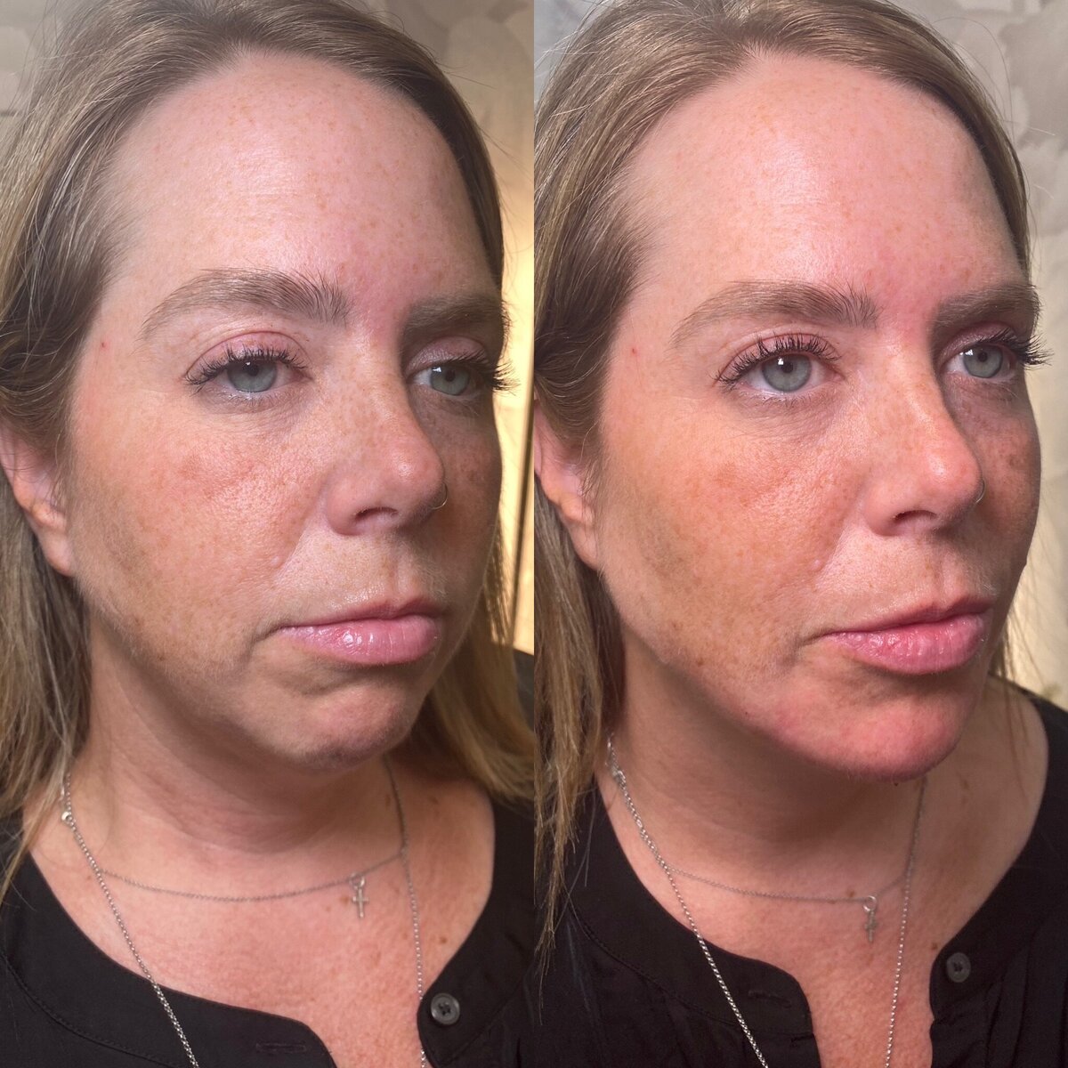 BalancedBeautyBotoxWestwood23
