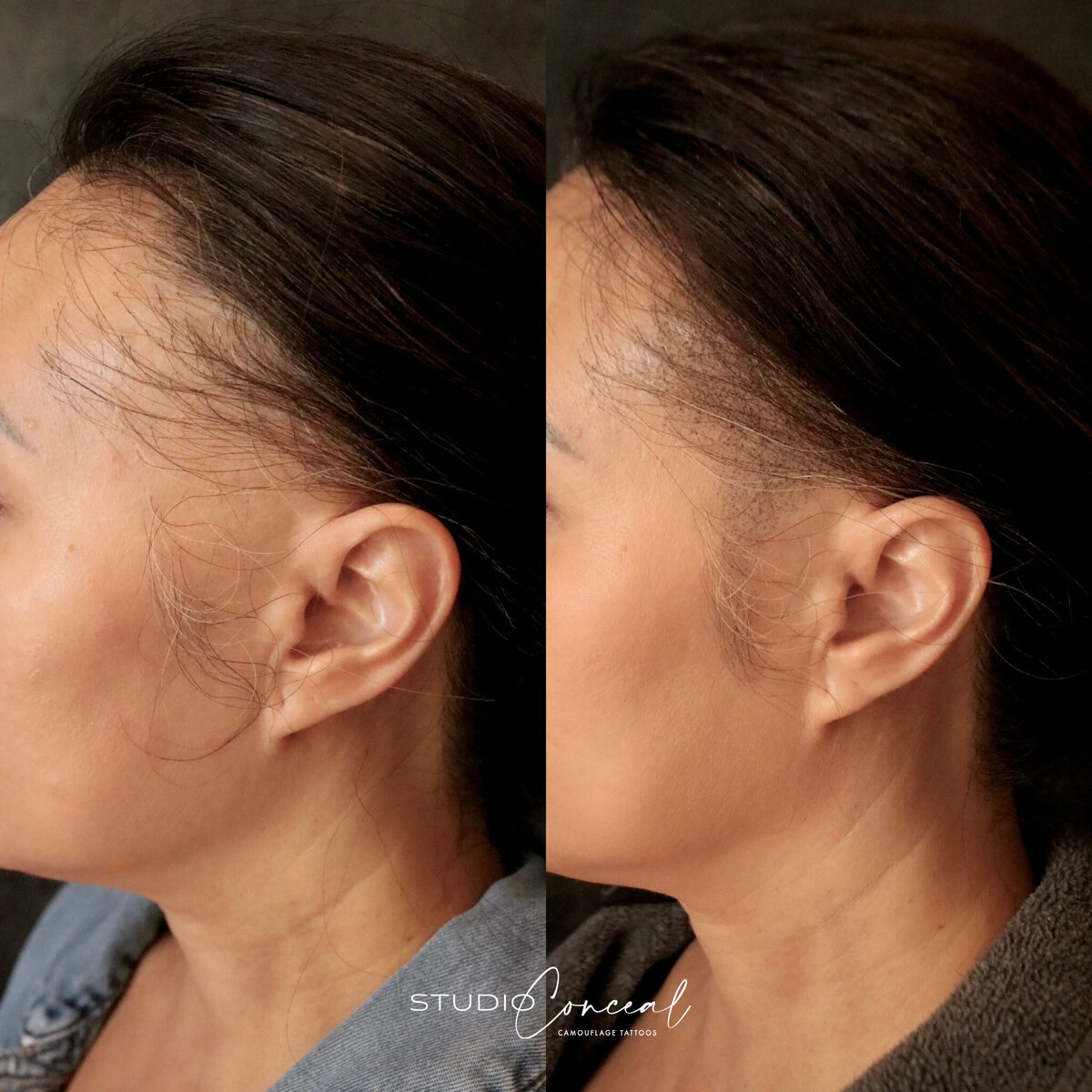 alopecia-hair-permanent-tattoo-arizona