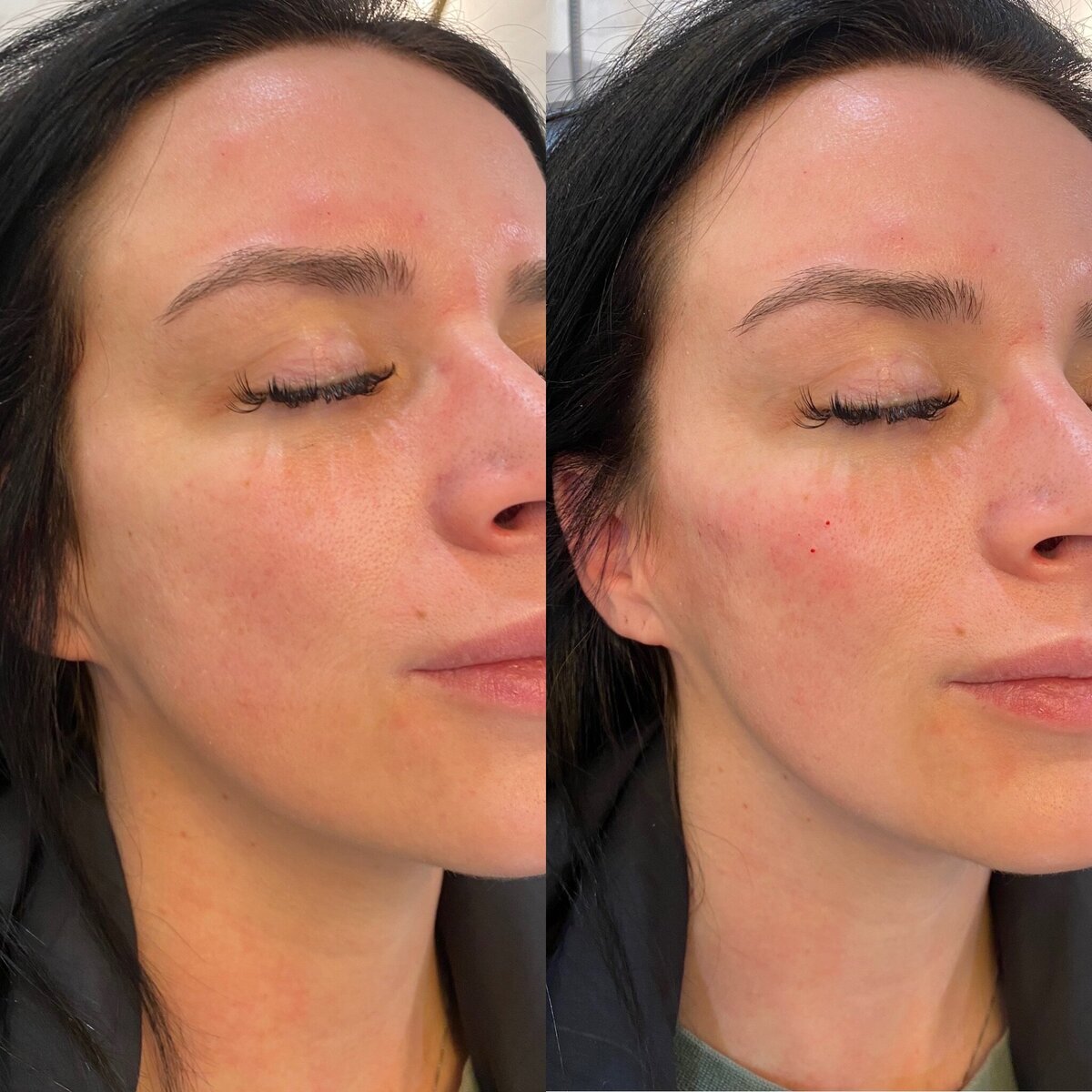 BalancedBeautyBotoxWestwood37