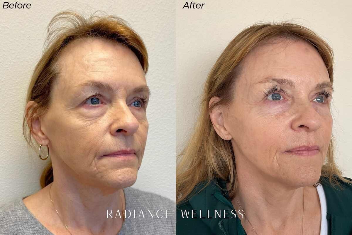 Sculptra-bna-nov13-2