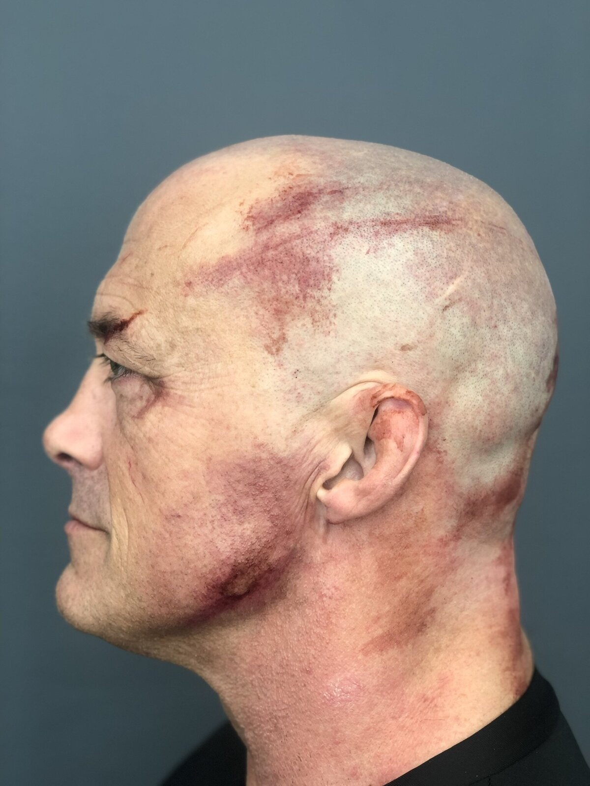 man-bald-bruises-scrapes-head-film-television-makeup