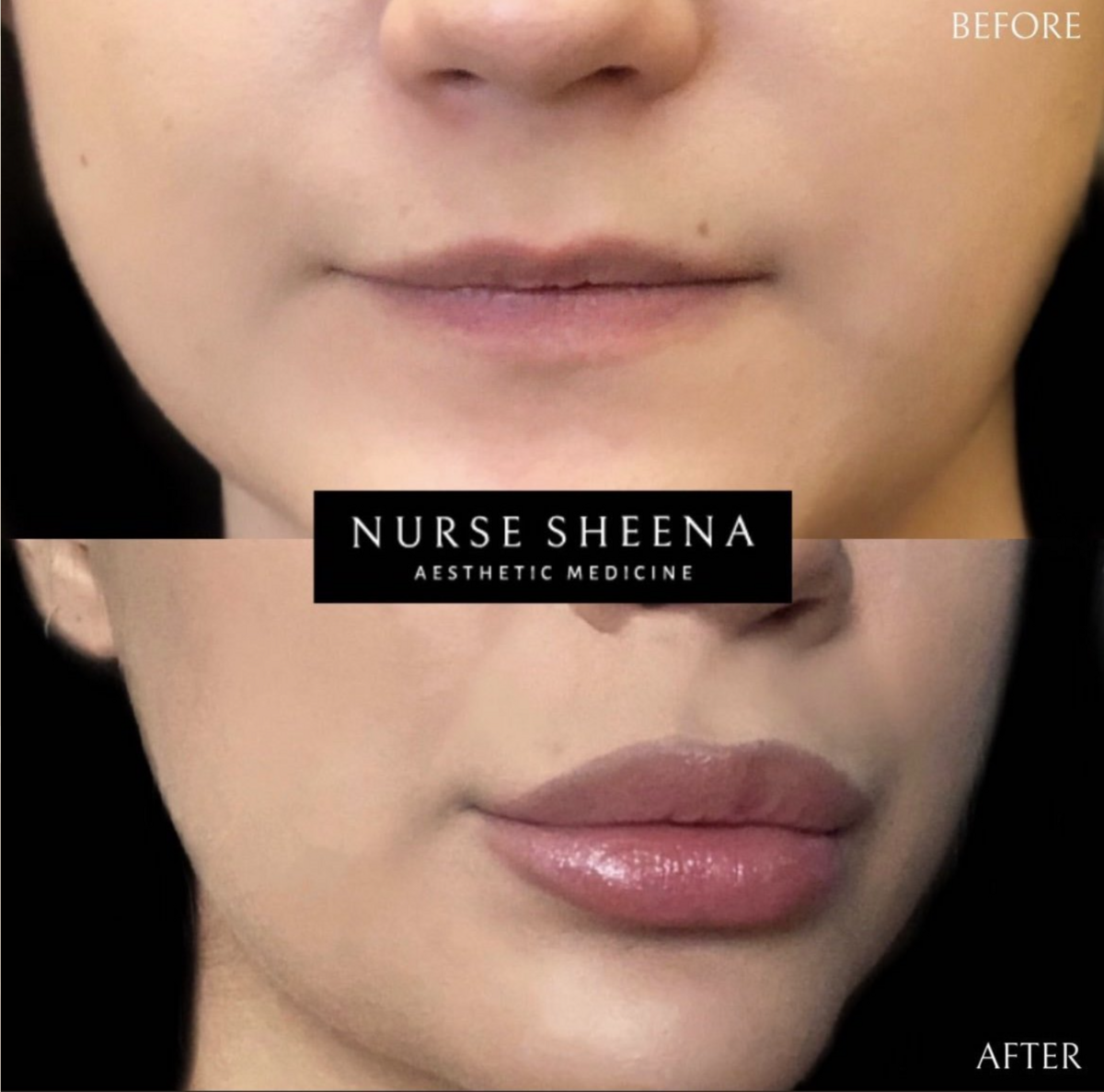 Lip Filler Results 2 by Nurse Sheena