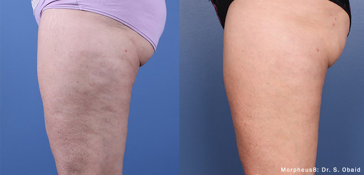 morpheus8-before-after-dr-s-obaid-preview-1