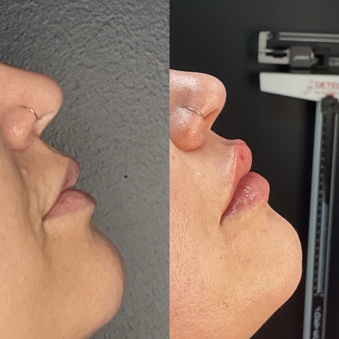 one lip filler session before and after