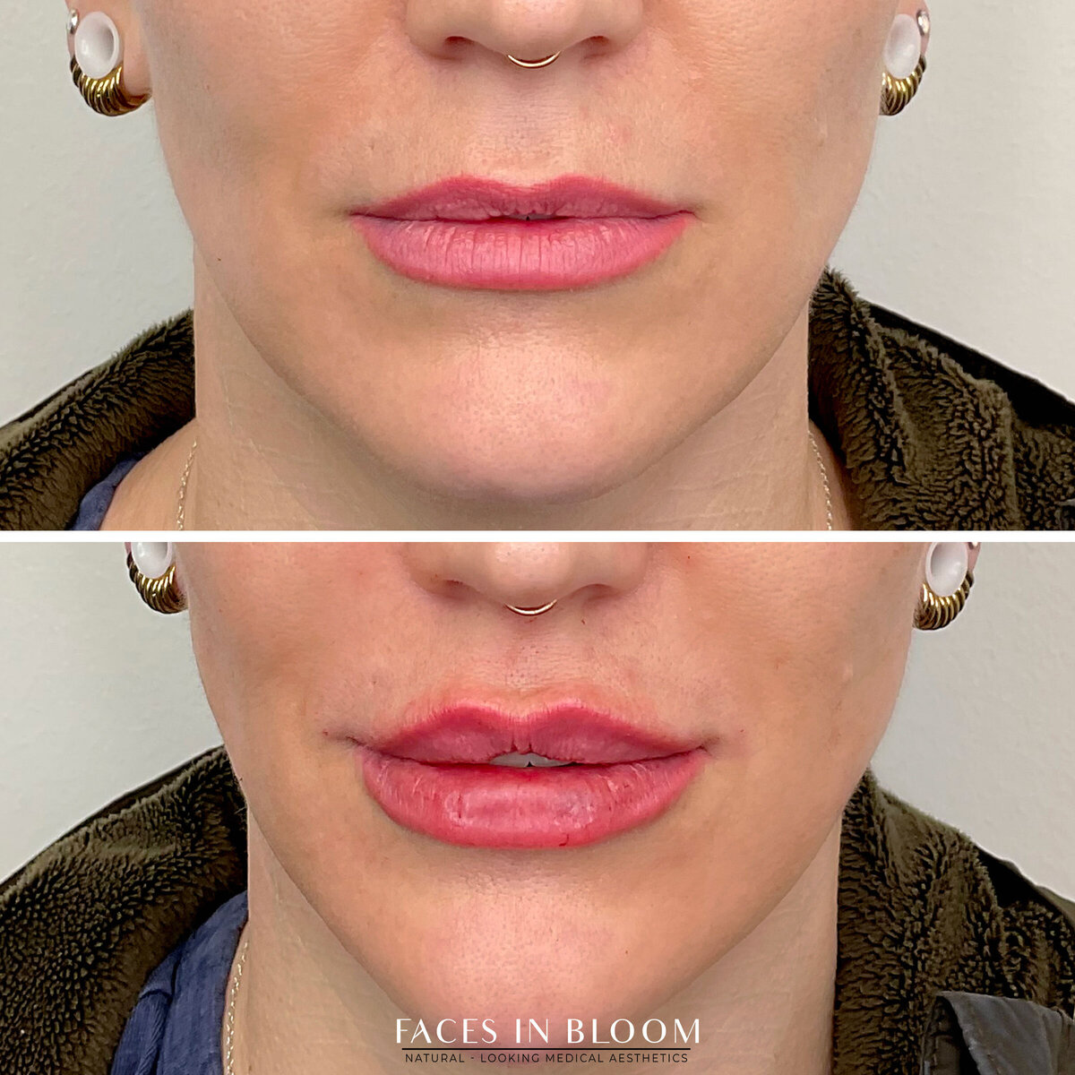 FACESINBLOOM_BEFOREAFTER_LIPS_05