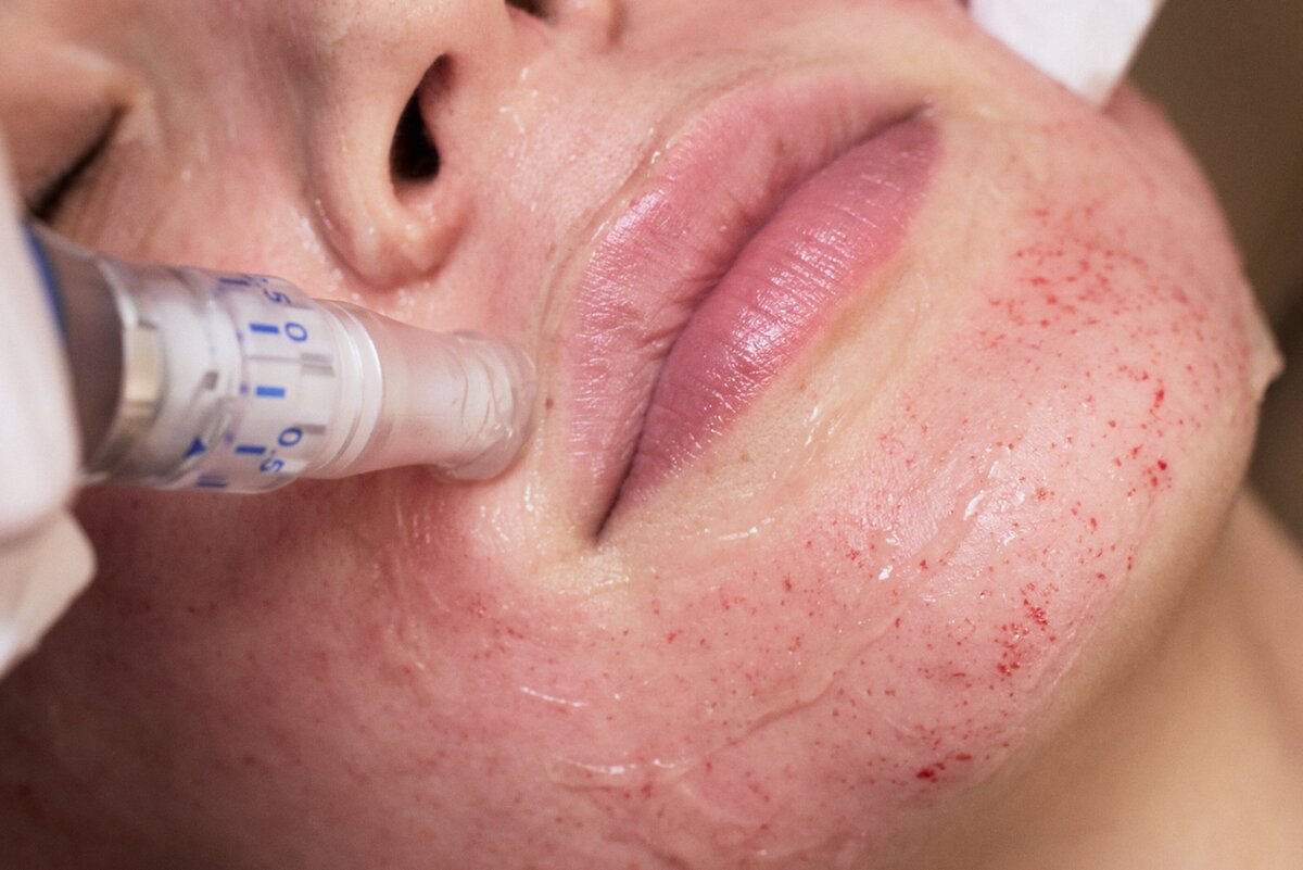 microneedle
