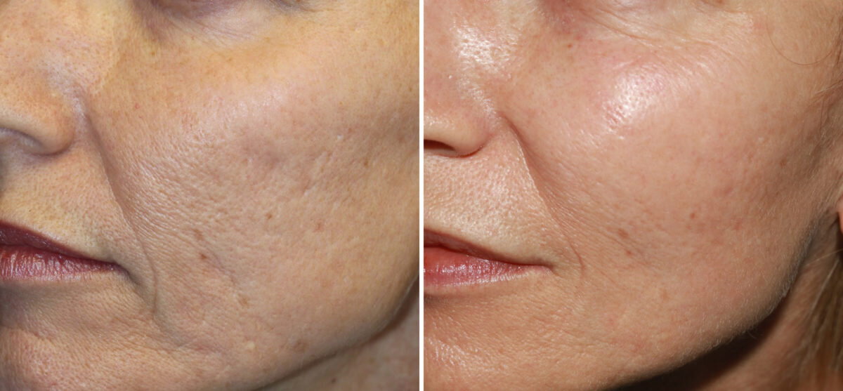 patient-14174-micro-needling-before-after-1200x557