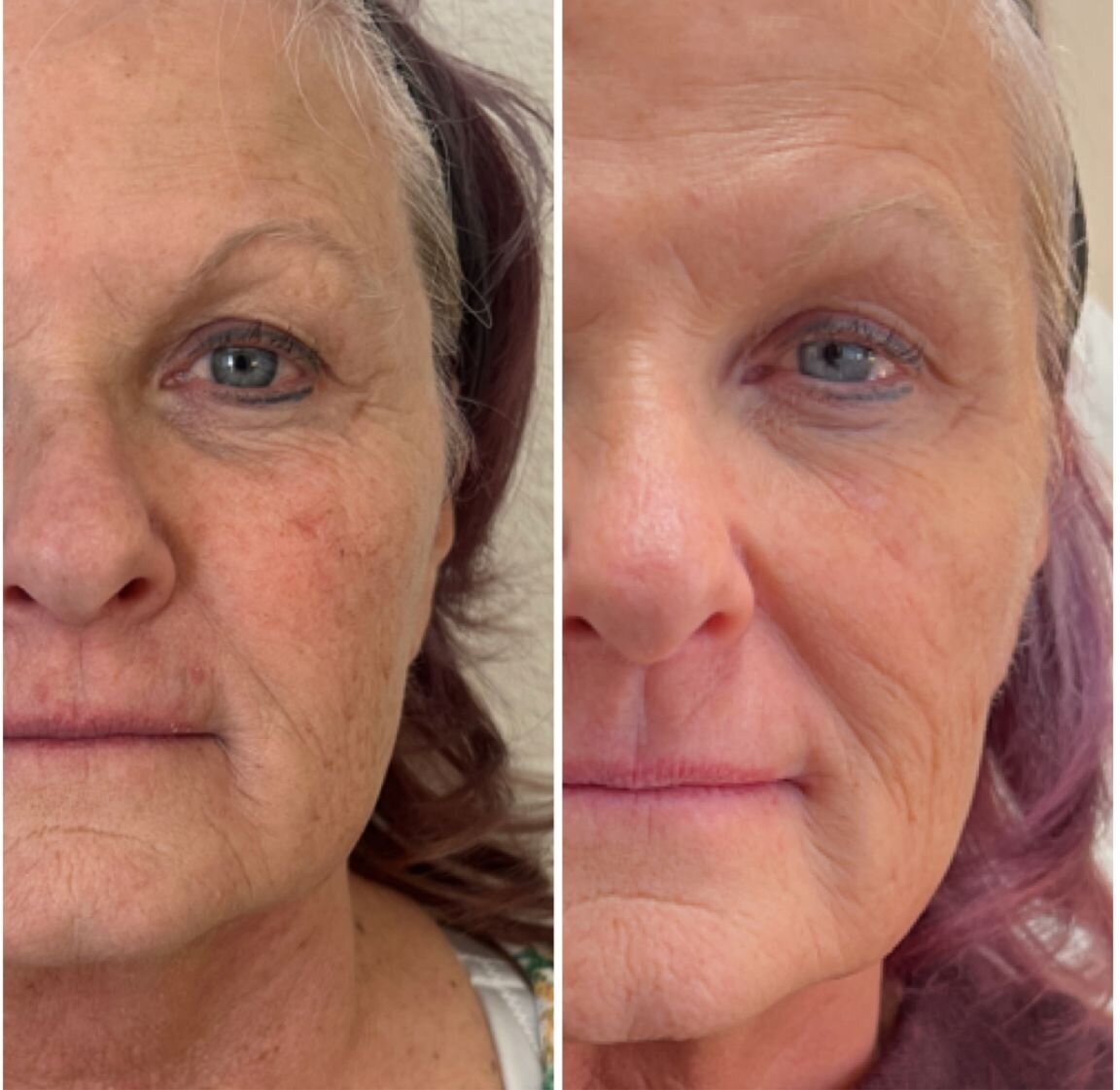 bbl-before-after-11