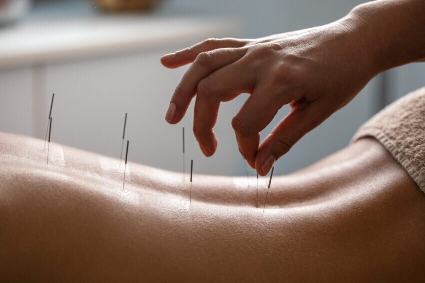 woman receiving acupunture on her lower back