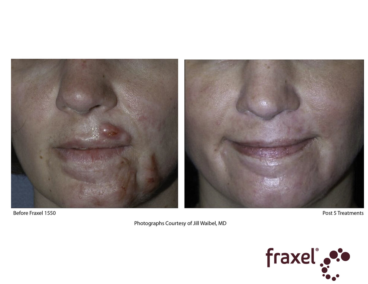 E034-Fraxel-1550_HiRes