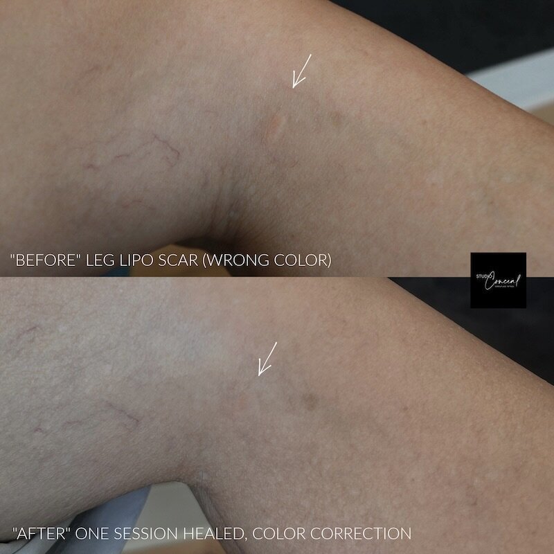 leg-lip-scar-camouflage-tattoo-3
