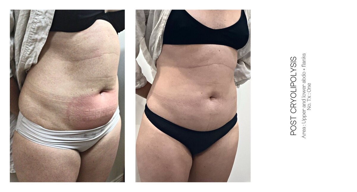Cryolipolysis Lower Stomach Before and After 3