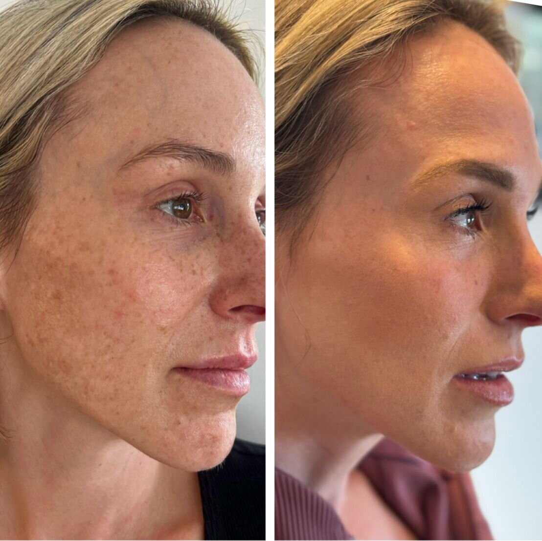 compressed-Moxi- BBL-before-after-09