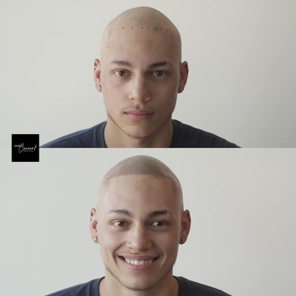 Alex-alopecia