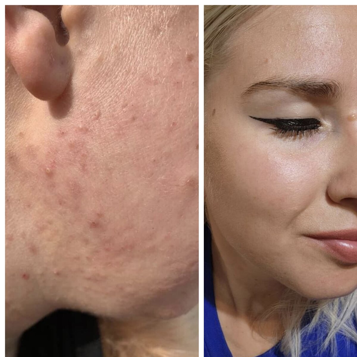 Clearer skin and improved texture achieved over time with holistic remedies.