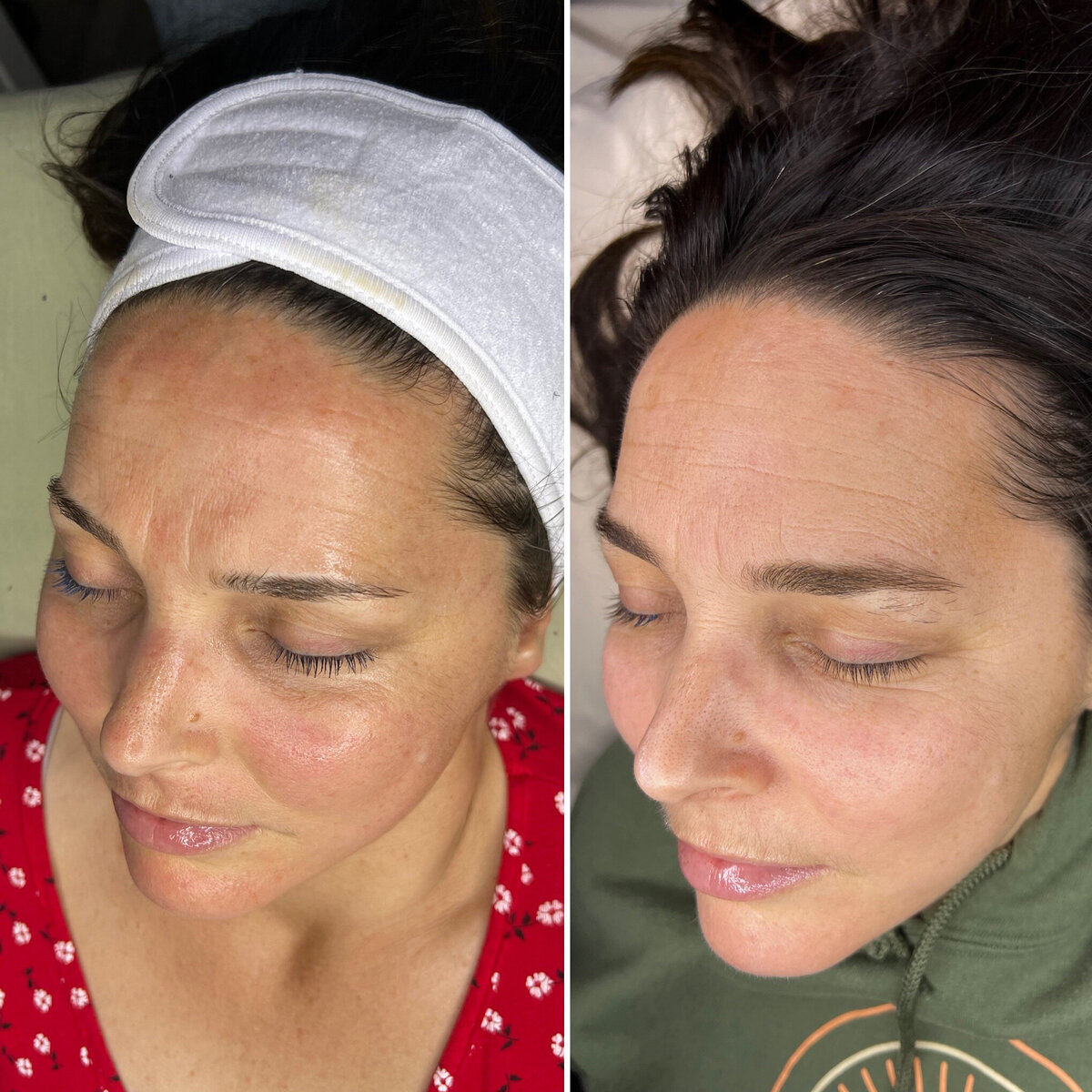 Ari Esthetics Before And After Facial
