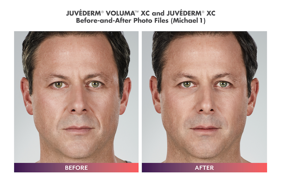 Juvederm_Treatment_Male