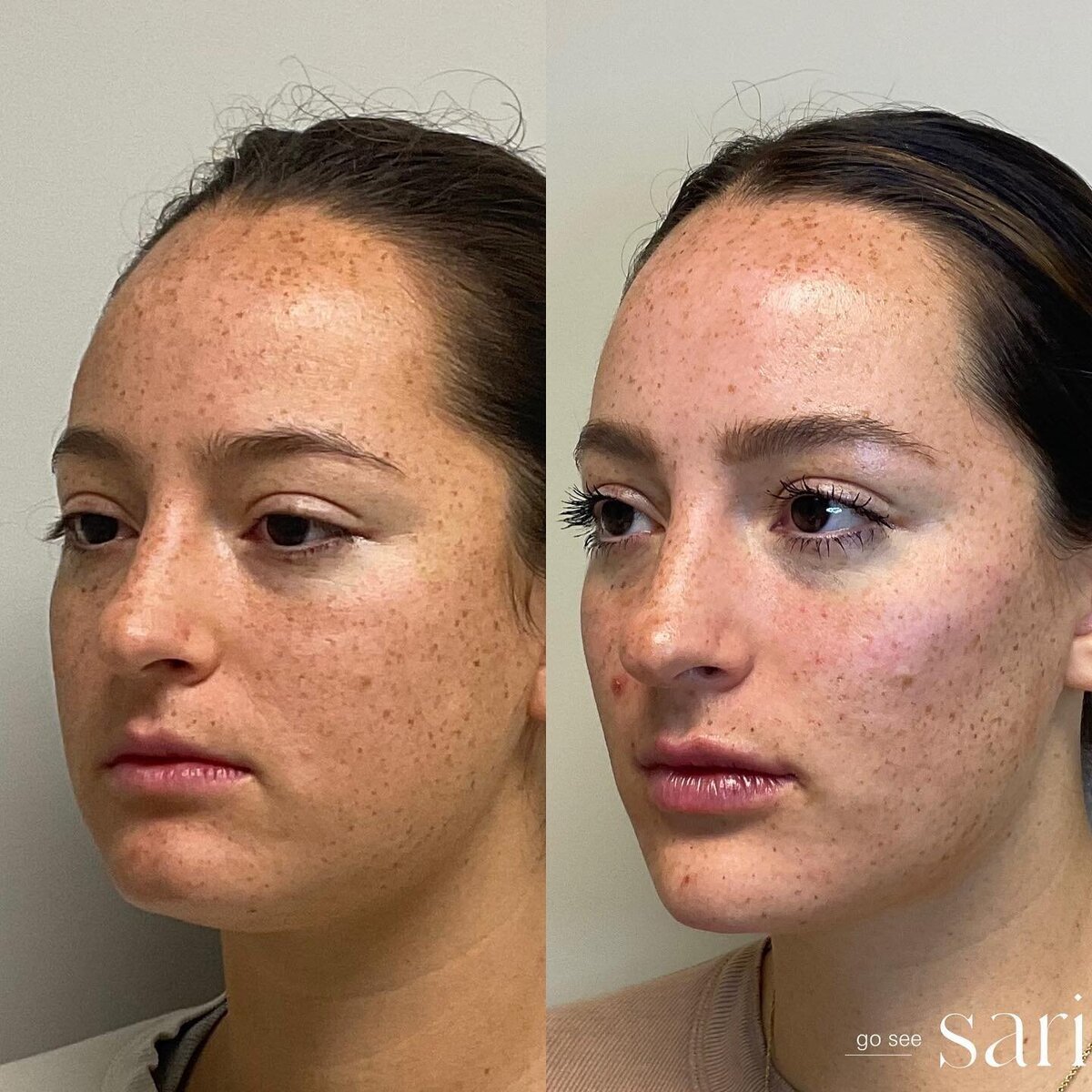 Facial Balancing at Go See Sari