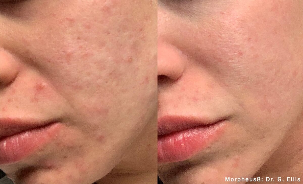 morpheus8-before-after-dr-g-ellis-preview-1