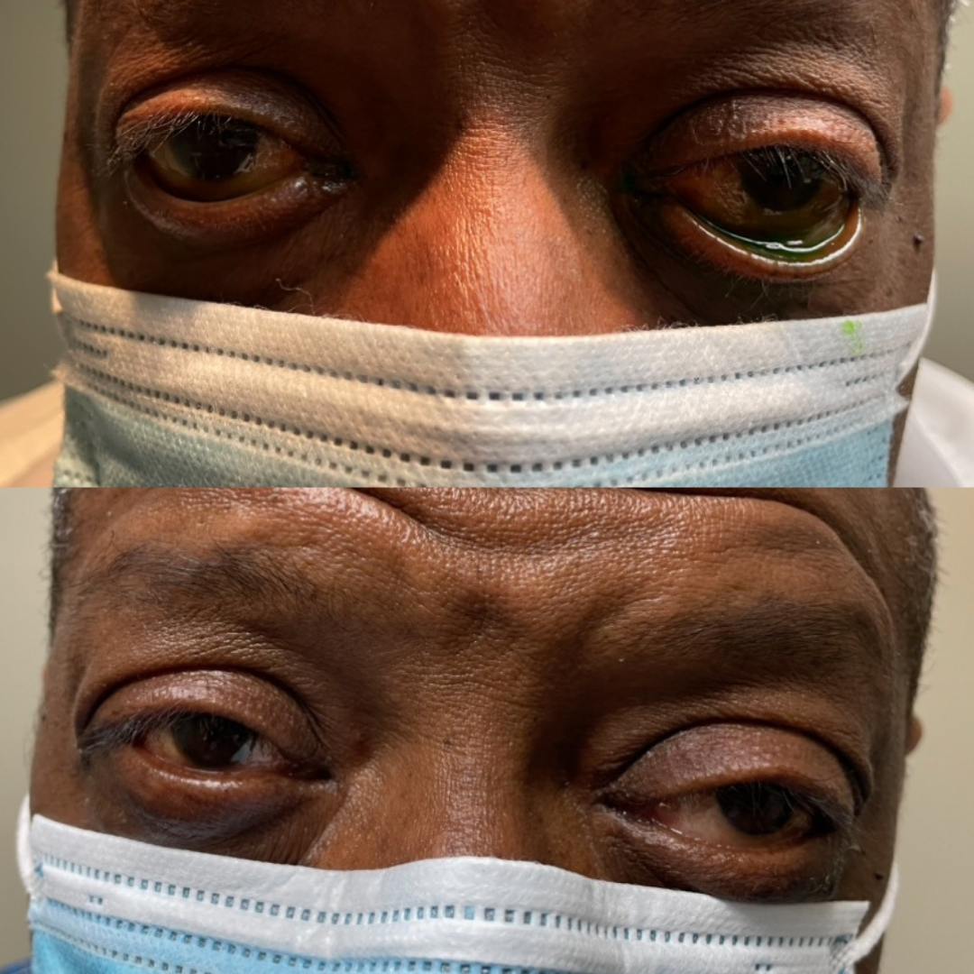 Bilateral ectropion repair