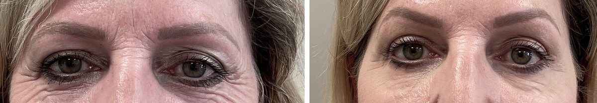 Botox gummysmile before after door cosmetisch arts Lizenka Adriaanse in Rotterdam
