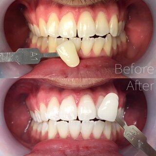 5bbd2e79ae9b4568d0717129_before-after-3-zoom-whitening.JPEG