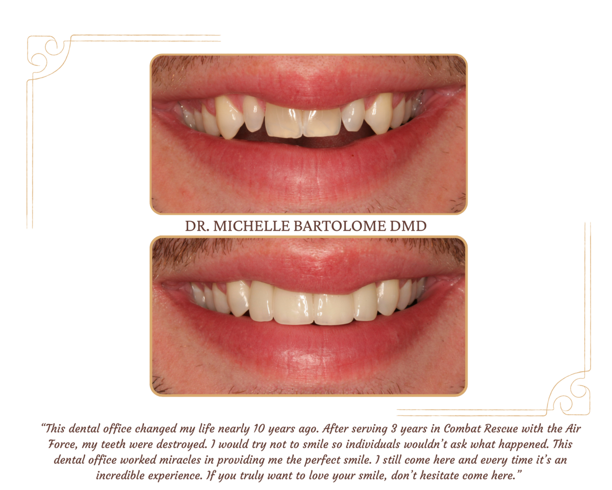 Smile Transformation