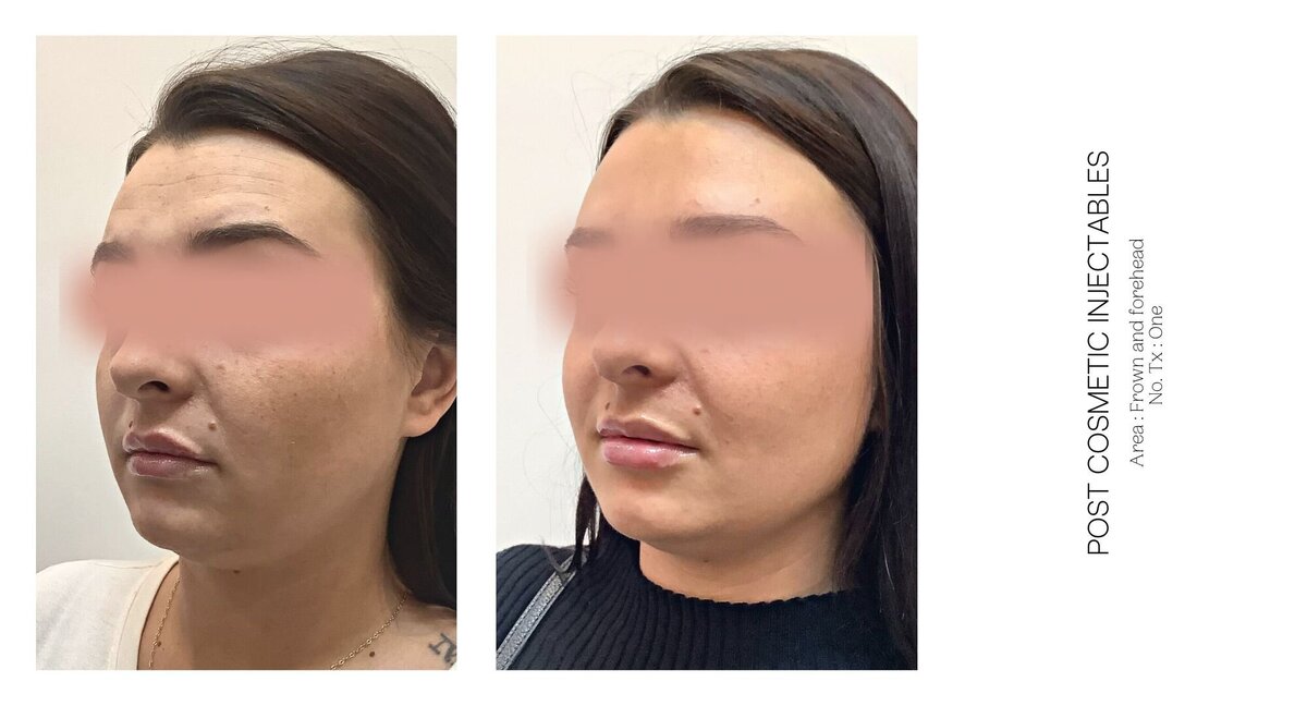 Best Cosmetic Injectable Frown Before and After 1