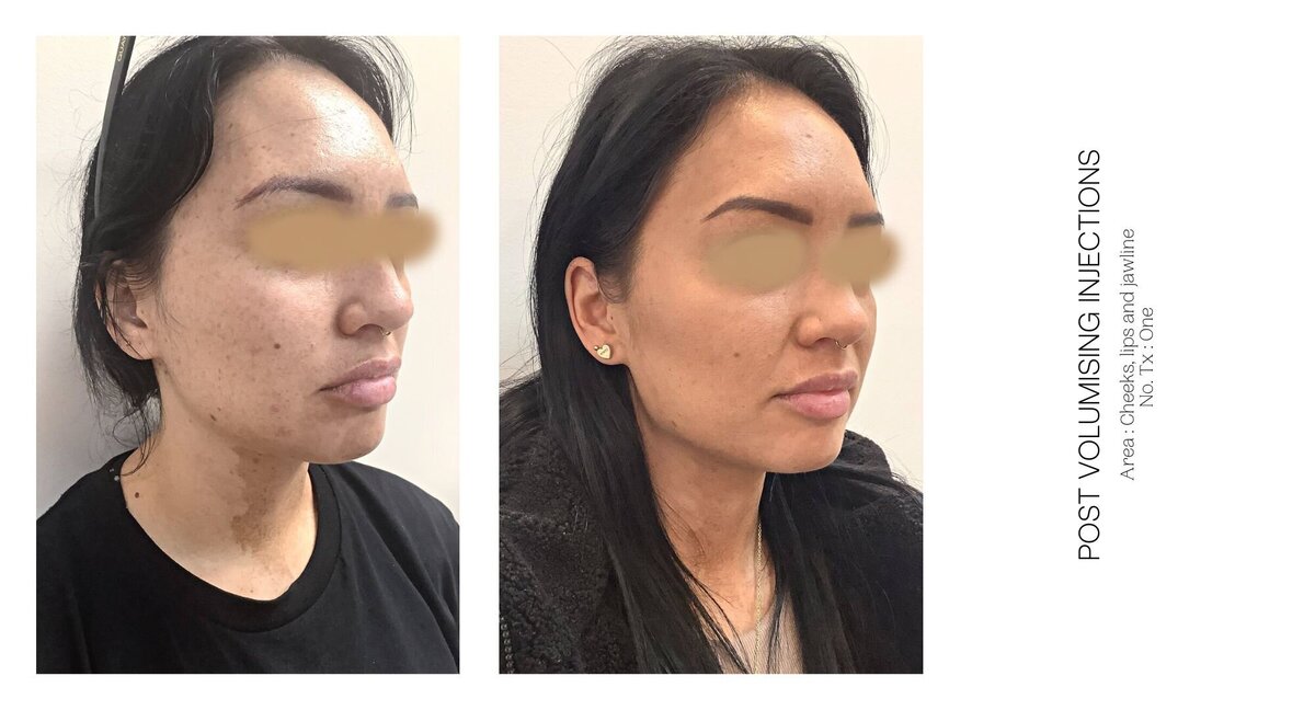 Cheek Injectable Before and After 1