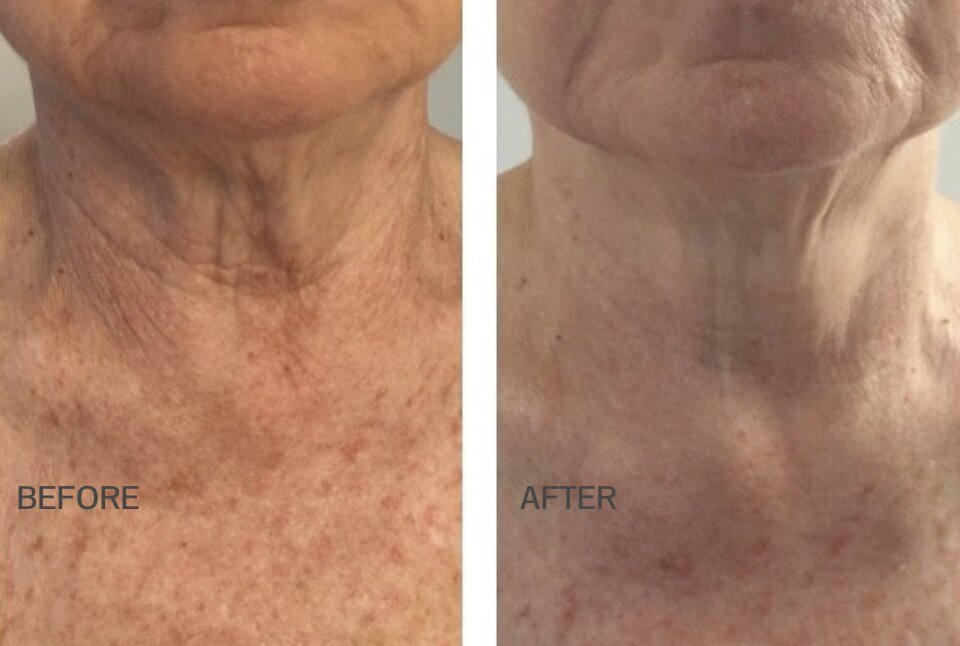 co2lift-pro-carboxytherapy-before-after-1