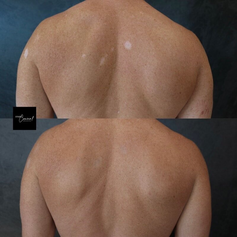 Hypopigmented-Scar-Tattoo-2