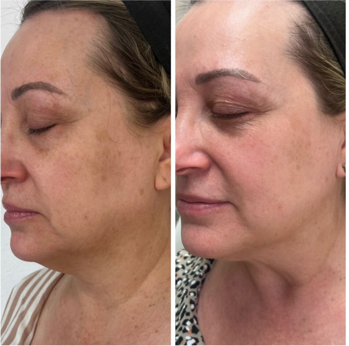 compressed-Moxi- BBL-before-after-17