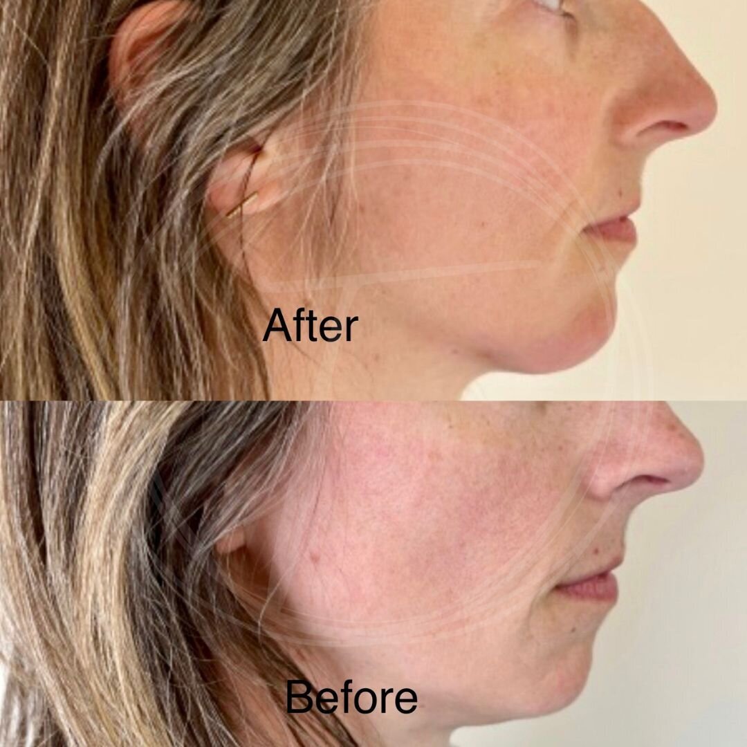 before:after results with look timeless - 4