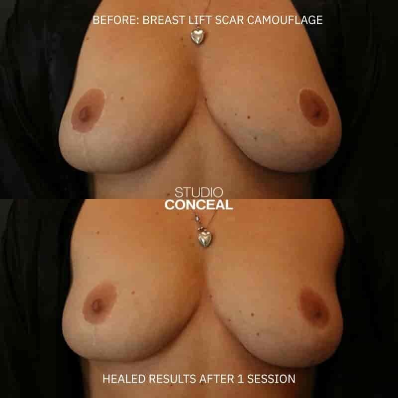breast lift explant scar camouflage