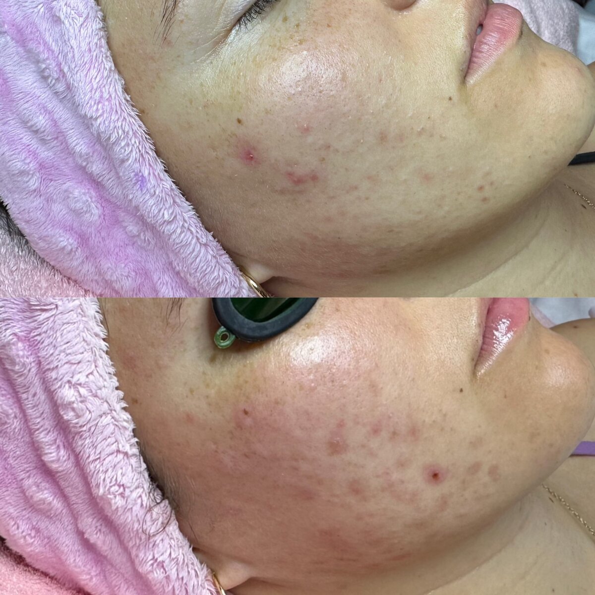 Acne Transformation Before & After